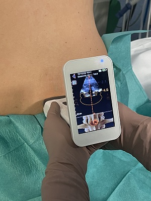 Un ecografo a ultrasuoni 3D agevola l'anestesia epidurale e spinale