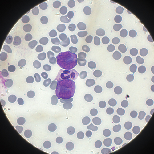 IL CONTENUTO INFORMATIVO DELL’OSSERVAZIONE MORFOLOGICA IN EMATOLOGIA